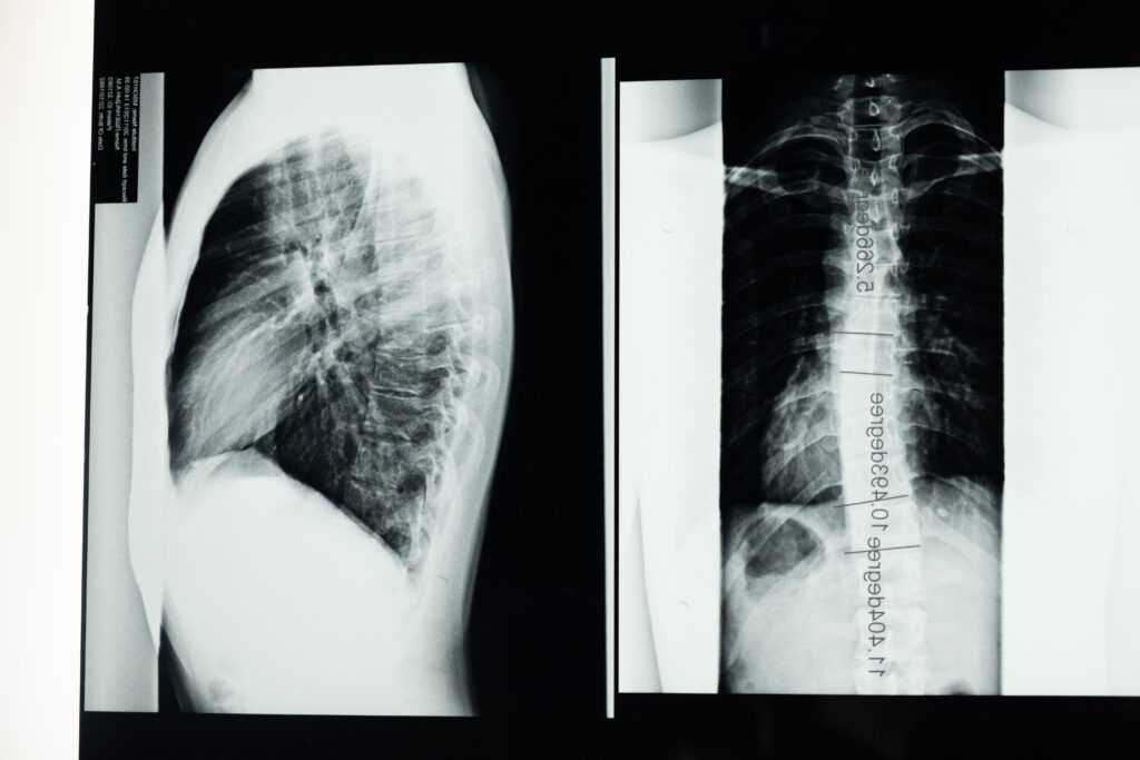 What Is The Difference Between Scoliosis And Kyphosis? - Curepedia